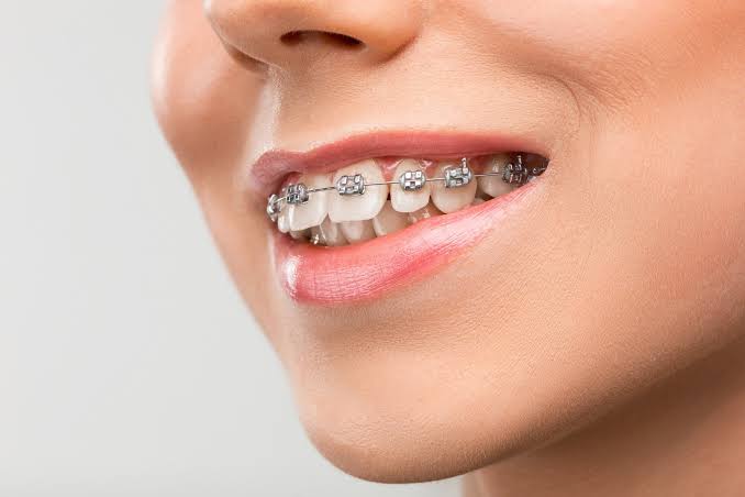 Braces at Keluarga Dental Smile, Sentul Kuala Lumpur