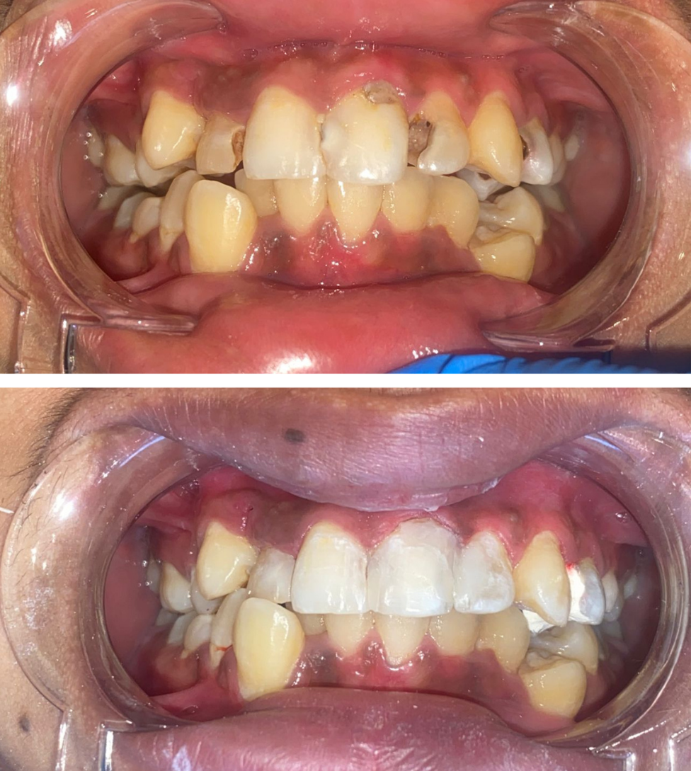 Before and after crown and bridge dental treatment in Sentul