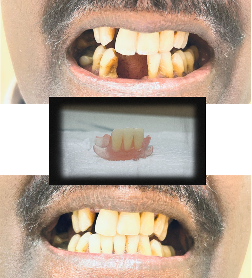 Before and after dental implant and filling treatment